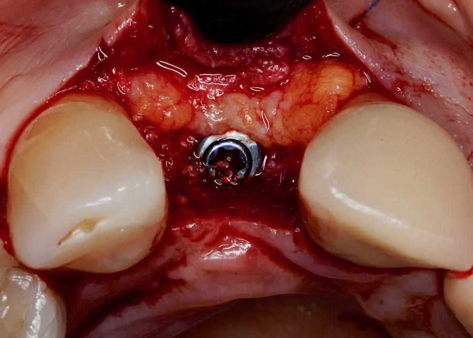Fig. 8: A subepithelial connective tissue graft is placed to improve soft tissue thickness, which may have a protective effect on the underlying marginal bone level and also improve the esthetic contours of the future reconstruction