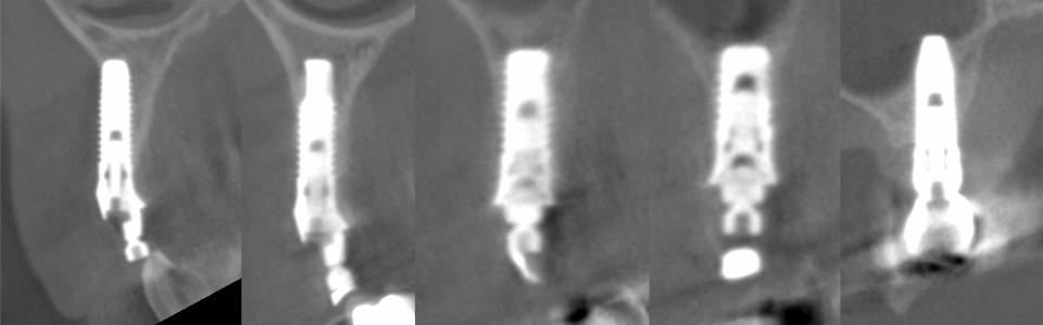 Fig. 11e: The corresponding 3D CBCT images document that all five implants can be considered to feature at least one type of malposition. Most common findings comprise absence of a facial bone wall, inadequate restorative axis, as well as insufficient inter-implant distance and errors in insertion depth. In addition, implant 17 has perforated the maxillary sinus