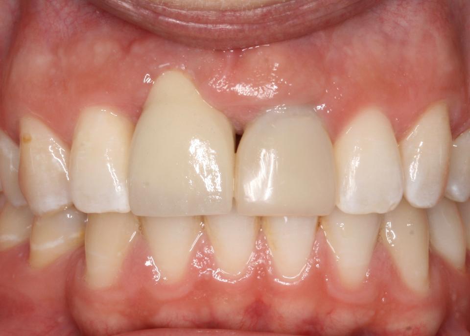 図９: 頬側への位置不良のため、歯肉縁が根尖側に移動し、審美的な結果が得られていない。インプラント埋入位置に対するマージン調整次第で、インプラントの撤去、補綴装置の再設計、または軟組織の造成が考慮される
