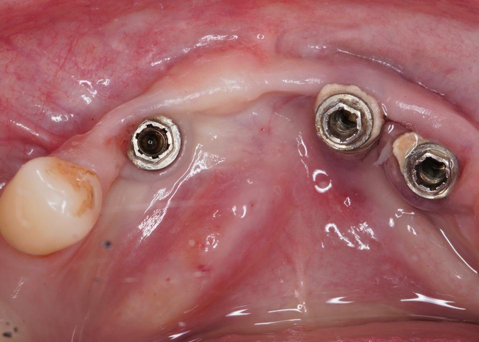 Abb. 11: Die Implantatposition und das unzureichende Angebot an keratinisierter Mukosa auf der lingualen Seite erschwerten die Durchführung der oralen Hygienemaßnahmen. In der Folge kam es zu einer periimplantären Mukositis und zur Zahnsteinbildung