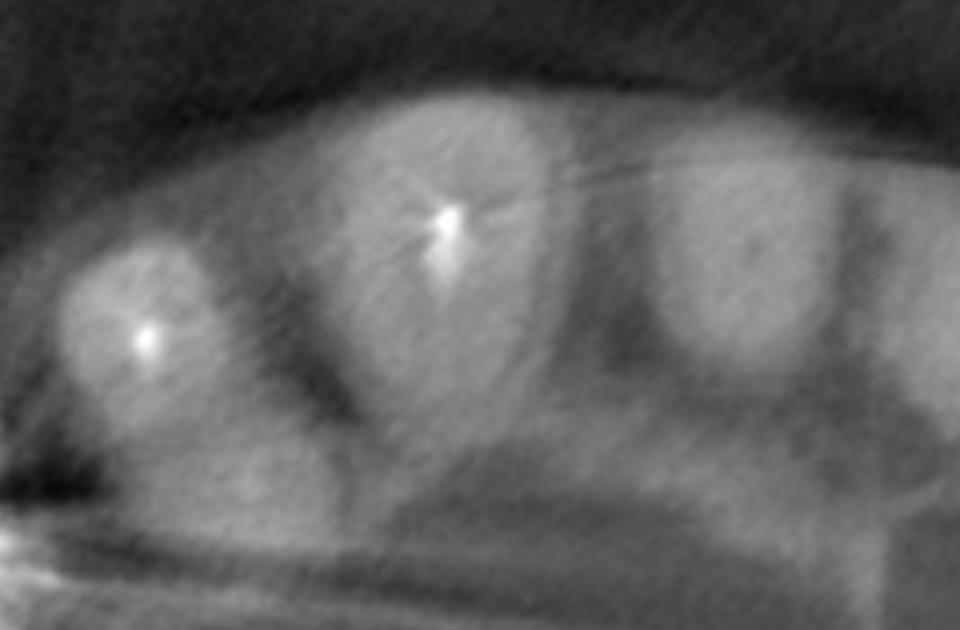 Fig. 3c: The coronal view shows a sufficient crest width of more than 6 mm mesially and distally to tooth 13