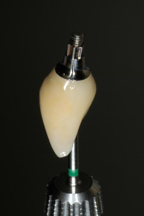 Fig. 9d: Final screw-retained crown
