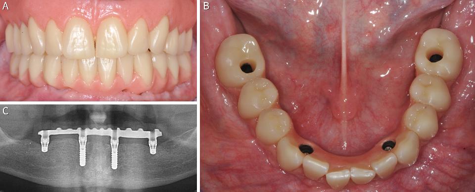 Fig. 11: Clinical (A) and radiological (B) findings of 66-year-old edentulous patient treated with an upper overdenture and a lower FPDP on 4 splinted implants, the posterior implants being 4-mm long (ongoing clinical study, courtesy of PD Dr. J. Wittneben)