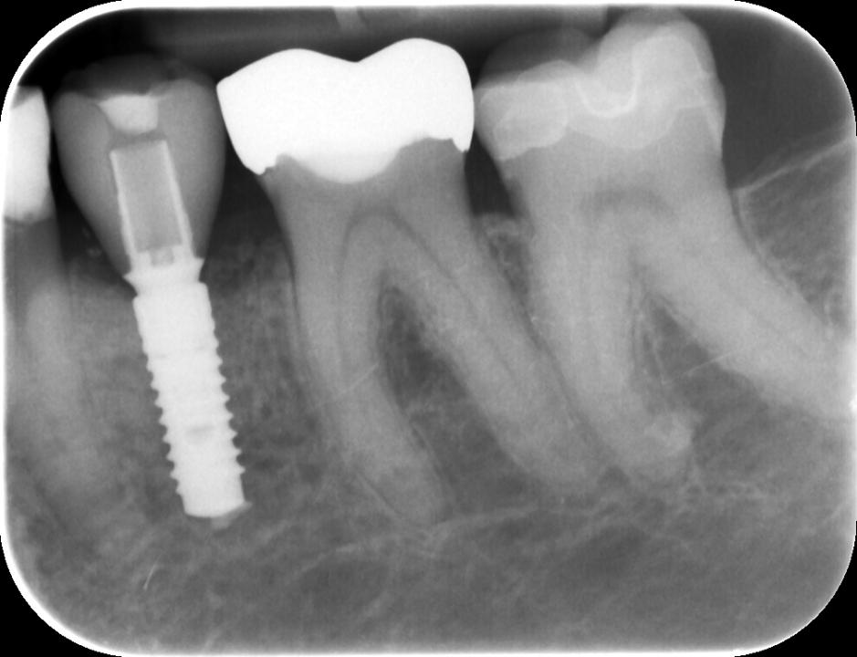 Fig. 13c: Radiograph of a hybrid abutment in region 35. The pre-fabricated metal part is visible on which the lithium disilicate crown was adhesively attached by the dental technician