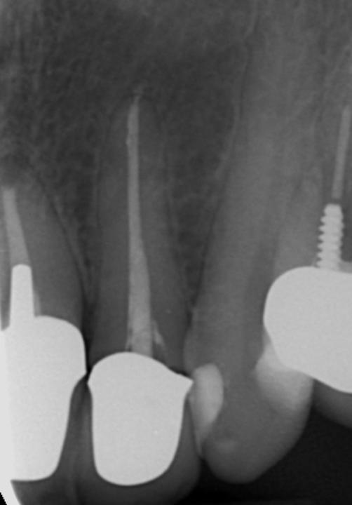 Fig. 6c: The corresponding radiographs reveal an axis problem of implant 11, endodontically treated and crowned teeth 12, 21 and 22 as well as a peri-apical chronic infection on root 21 