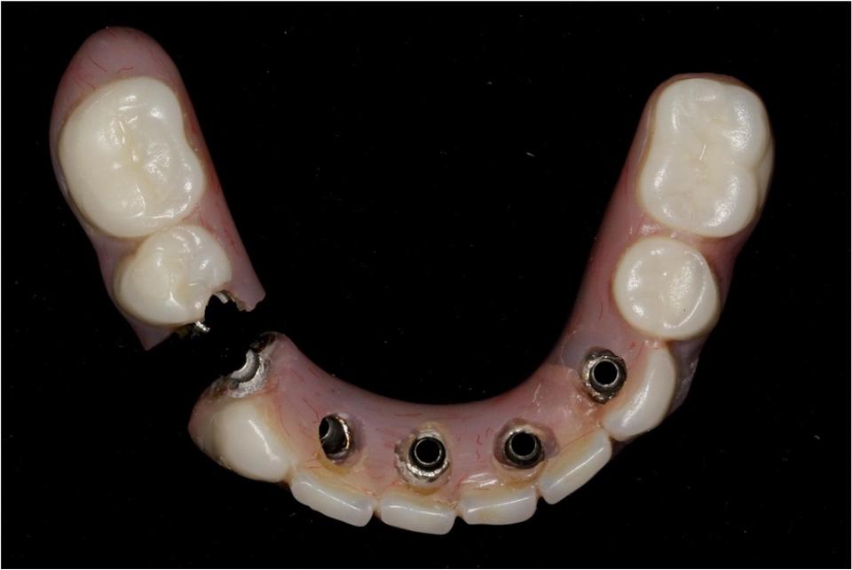 図４: この画像は、上顎の天然歯列に対合するインプラント支持固定義歯の極端な、しかし珍しくはない結果を示している。数年間の使用により、フレームワークの最も脆弱な部分であり、カンチレバーの咬合負荷により最も応力のかかるターミナルアバットメントのスクリューアクセス部から破断が生じたものである。インプラントのカンチレバー荷重を軽減または除去することが最良の解決策となる。