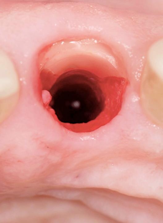 Fig. 4: Shield on the buccal side of the socket