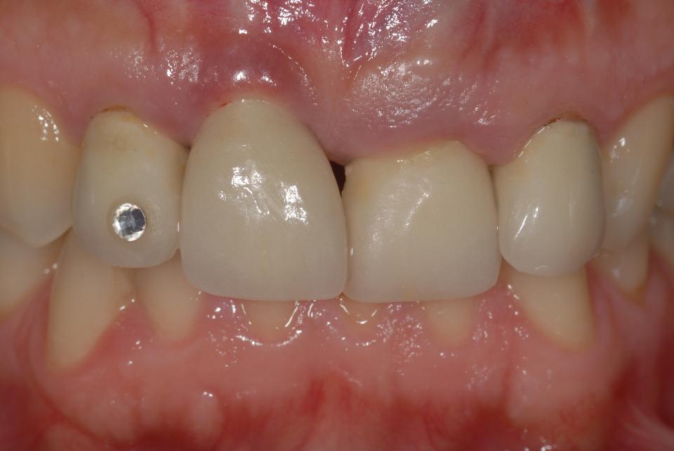 Fig. 6a: Initial frontal view of a 45-year-old female patient with a high smile line exposing an irregular soft tissue course, a mid-facial mucosal recession and chronic marginal infection with swelling at implant site 11, a missing central papilla as well as a visible crown margin at tooth 22