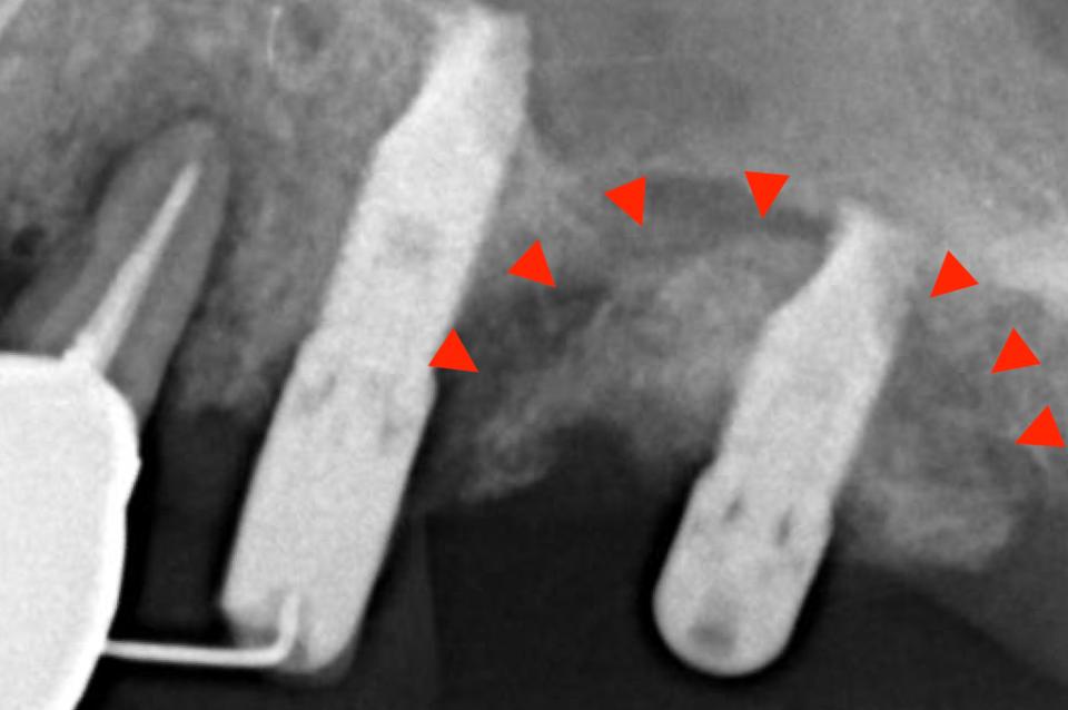 Fig. 12b: L'immagine radiografica mostra una chiara linea di separazione tra l'osso necrotico con l'impianto dentale e l'osso naturale circostante. L'impianto adiacente non mostra chiari segni di necrosi