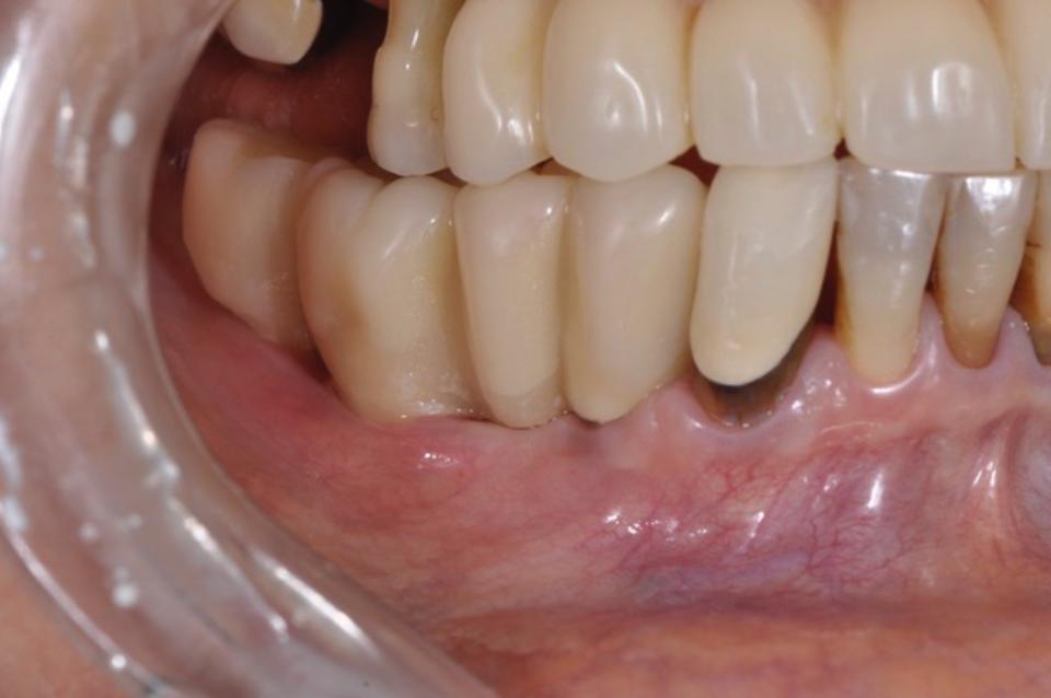 Fig. 21c: Clinical view showing elongated crowns to fill restorative space