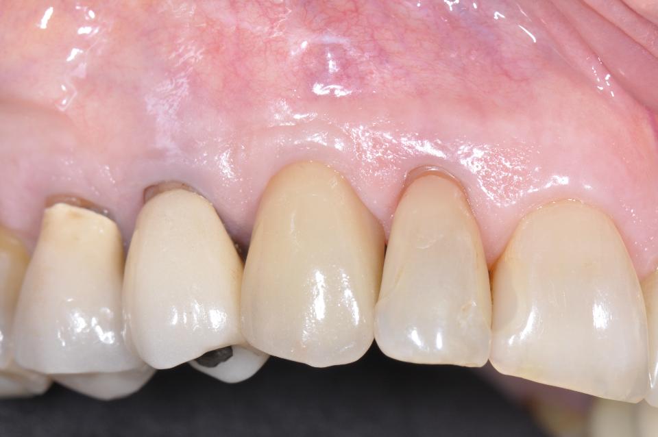 Fig. 3v (a): The 3-year follow-up examination shows stable peri-implant soft tissues. The patient has an excellent home care resulting in a healthy peri-implant mucosa free of inflammation