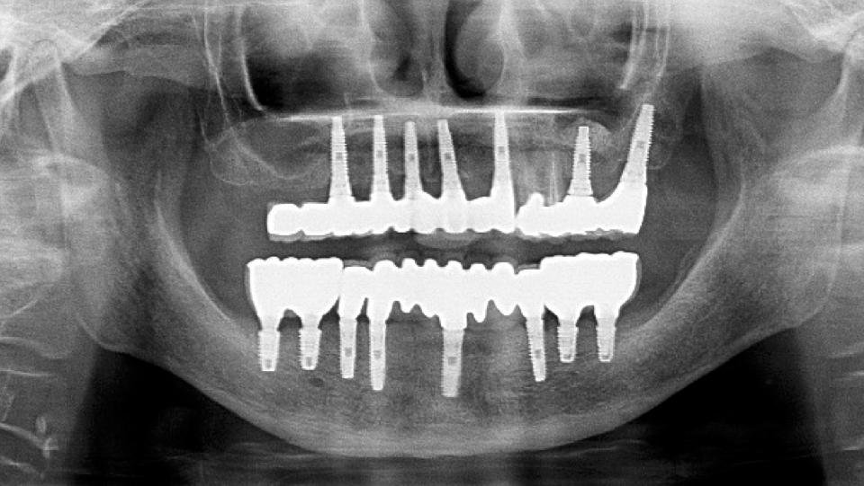 Fig. 14a: O sequestro relacionado ao implante/ONMRM ocorreu ao redor de uma prótese dentária de oito elementos suportada por quatro implantes após alguns anos de função. A imagem radiográfica mostra tecidos duros peri-implantares saudáveis