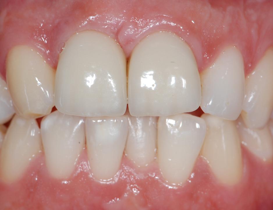 Fig. 11: Healthy peri-implant outcomes at the 11th year of externally connected zirconia abutments supporting cemented all-ceramic single crowns in region 11 and 21