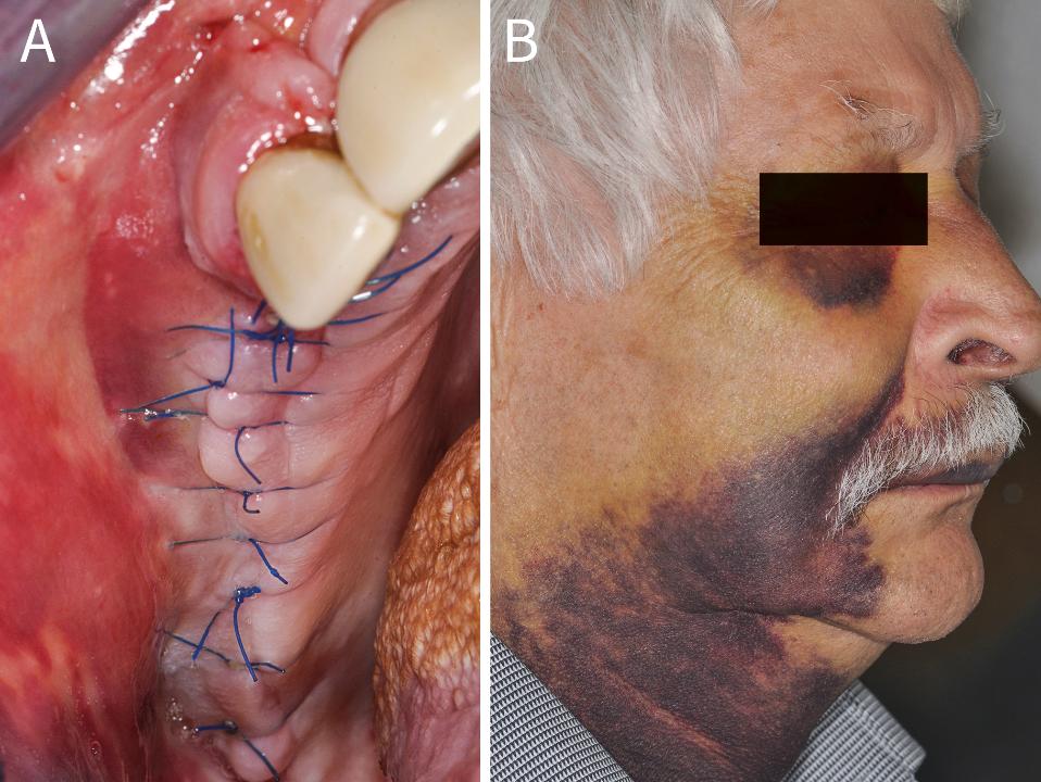 Fig. 2: Pronounced intraoral (A) and extraoral (B) hematoma one week after staged sinus floor elevation and GBR in a patient with antithrombotic medication (acetylsalicilic acid 100 mg/d) and suspected hemostatic disorder
