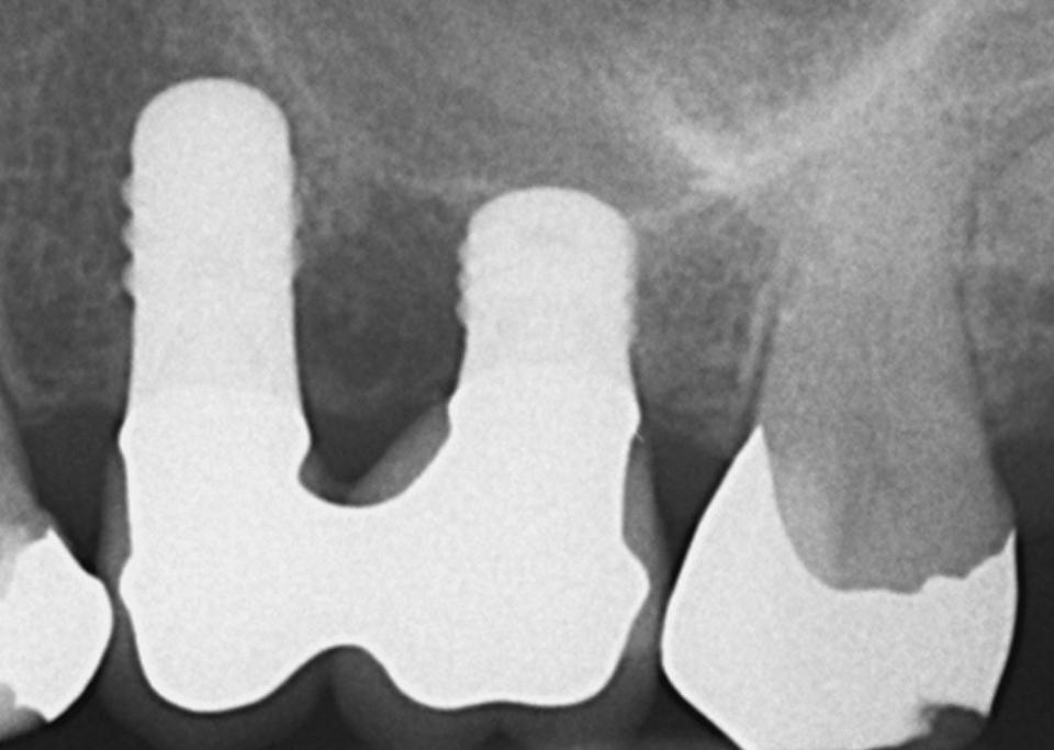 Fig. 5b: The 2-year follow-up radiograph shows stable bone crest levels at both implants. As usual, the two crowns are splinted