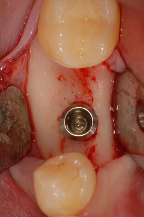 Fig. 2: Implant placement in region 46