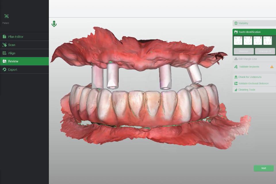 Fig. 5: The distance between implants (edentulous space) often affects the overall accuracy of intraoral scans greatly