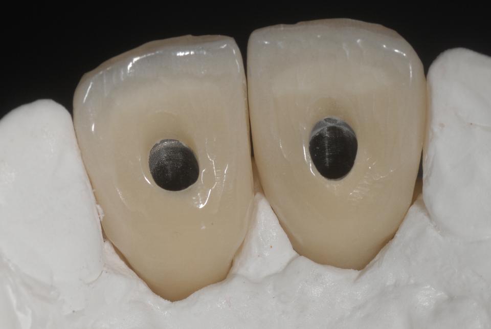Fig. 6f: Close-up view of the palatal aspect of the working model, displaying the two directly screw-retained provisional acrylic implant crowns on titanium copings