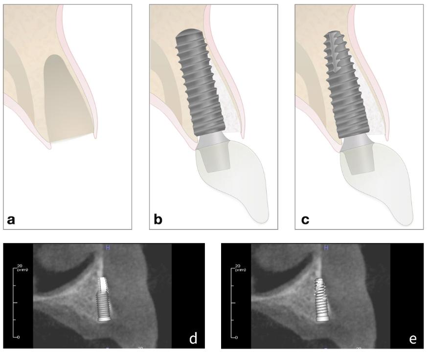 Fig. 2: Increased apical dehiscence for cylindrical implant compared to tapered implant in the same position in the same ridge. a: Socket with thin buccal plate. b: Cylindrical implant perforating the buccal plate apically c: Tapered implant within the alveolar contours d: Radiograph simulating cylindrical implant with apical perforation e: Radiograph simulating minimal perforation with tapered implant