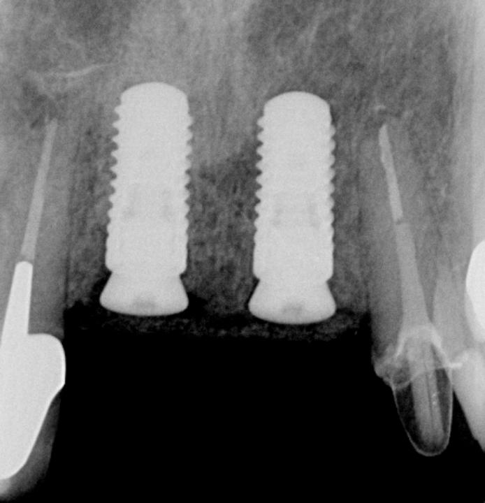 Fig. 6d: This peri-apical radiograph documents the situation after removal of implant 11 and tooth 21, followed by the staged insertion of two bone level implants according to the concept of early implant placement with simultaneous contour augmentation