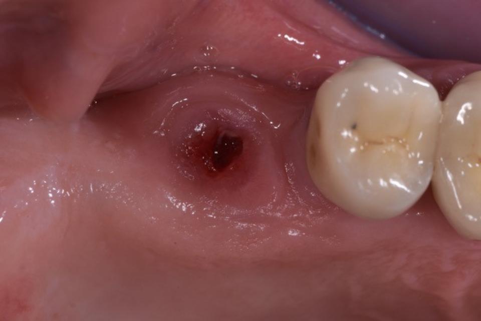 Fig. 1d: Fratura do implante relacionada ao bruxismo na posição do 16 (primeiro molar superior direito) após 25 anos (paciente do sexo masculino, 75 anos, restauração com implante fixo na mandíbula) [Fonte: NU Zitzmann]: Imagem clínica da região do 16