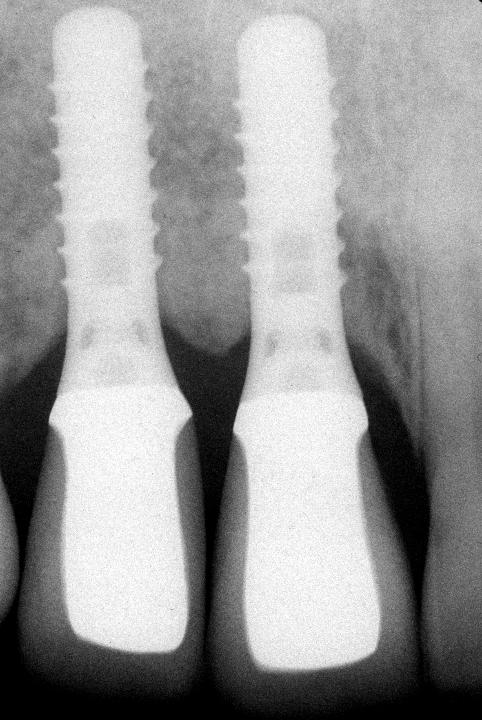 Fig. 6b: The corresponding x-ray confirms stable peri-implant bony conditions, but a typical flattening of the inter-implant bone crest