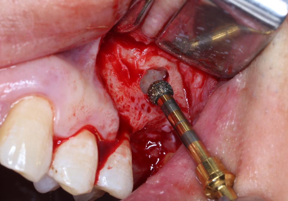 Fig. 8: The dentium advanced sinus kit (DASK) system consists of a series of diamond-studded concave burs along with a series of hand instruments that are used to create a small window on the maxillary lateral wall