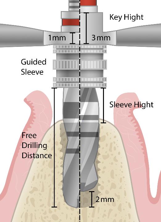 Fig. 5a: Free drilling distance vs osteotomy depth calculation in sCAIS: free drilling distance = drill length – (sleeve length + guided key height); osteotomy depth = drill length – (sleeve length + guided key height + sleeve height); osteotomy depth = implant length