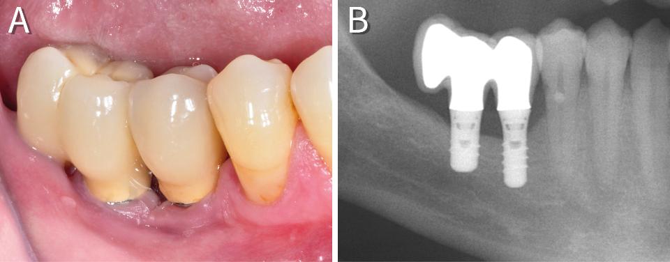 Fig. 7: Splinted, cantilever implant restoration on a 6-mm short implant (4.8-mm diameter) and an 8-mm long (4.1-mm diameter) implant after 10 years in function (A, B)