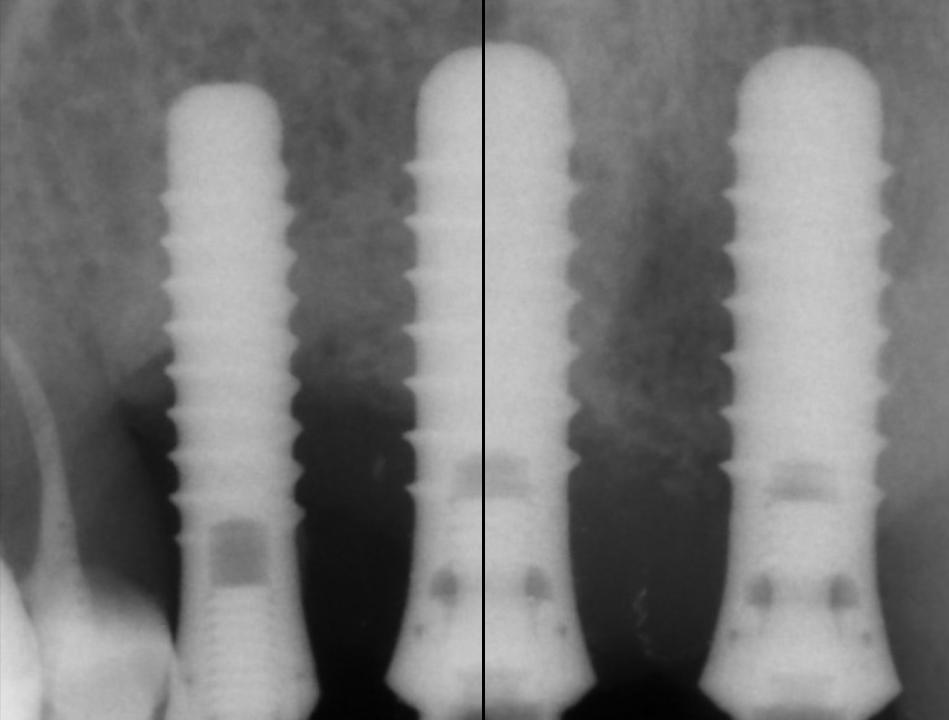 Fig. 9b: The conventional 2D x-ray reveals advanced peri-implant bone loss, particularly marked around implants 12 and 11. Inter-implant distances, however, can be considered sufficient