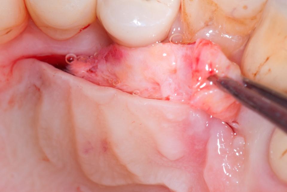 Fig. 8: A subepithelial connective tissue graft is harvested from the palate using the single-incision technique