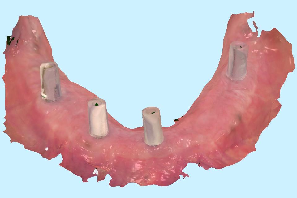 Fig. 27: Example proprietary file representing a mandibular intraoral scan of 4 dental implant scan bodies. The STL file in Fig. 24 was converted from this proprietary file format, and the surface texture and color cannot be preserved after conversion