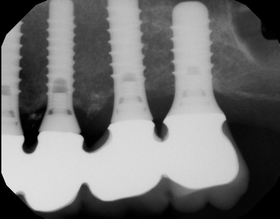Fig. 16: Well-spaced posterior tissue level implants with inter-implant bony peaks supporting papillas, 23 years post-op