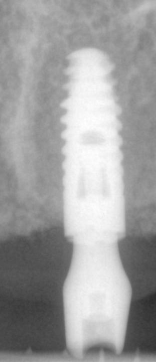 Fig. 2b: Una radiografía periapical muestra la ausencia de pérdida ósea marginal