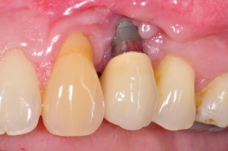 Fig. 4a: Clinical view of a tissue level implant restoration at site 24. Note both the severe mid-facial mucosal recession and exposure of the coronal part of the implant