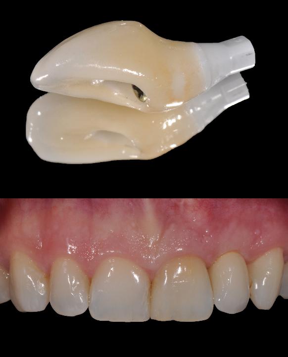 Fig. 8: Internally connected one-piece zirconia abutment and all-ceramic crown inserted in region 22