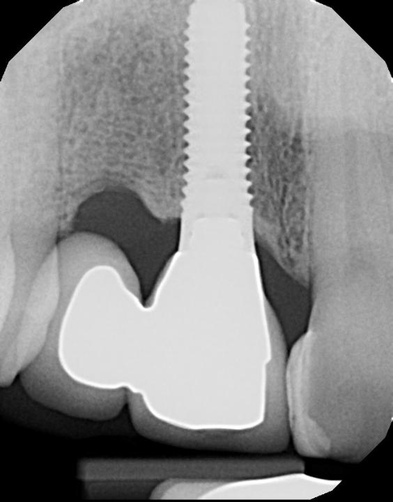 Fig. 18b: Radiograph showing excellent crestal bone maintenance
