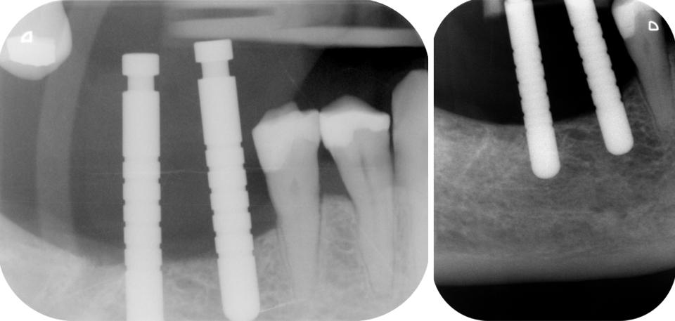 Fig. 1b: Intra-operative radiographs. Use of a depth gauge for implant positioning