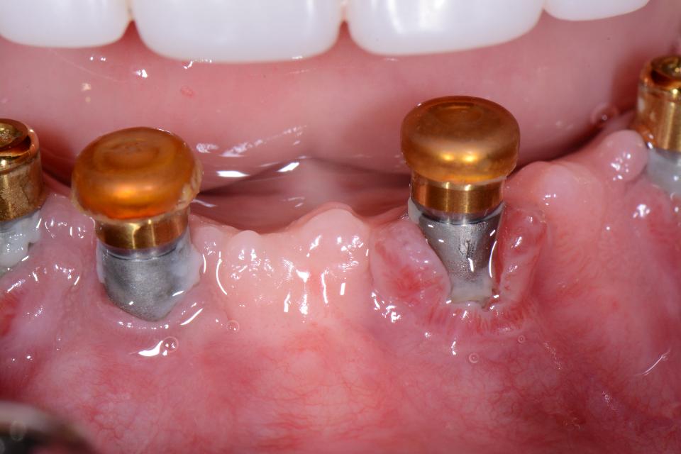Fig. 2a: The presence of plaque on implants and abutments is revealed by this intraoral photograph of two mandibular implants supporting an overdenture. Even removable prostheses can harbor plaque if the prosthesis is not removed daily or the abutments and implants are not cleaned. Marked peri-implant mucosal inflammation and resorption are both evident. The reported incidence of peri-implantitis in the implant overdenture patient is high