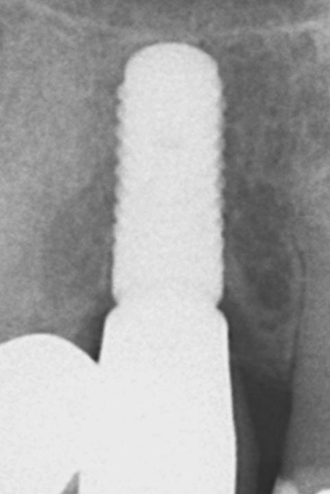 Fig. 3v (b): The corresponding periapical radiograph confirms the stability of the crestal bone