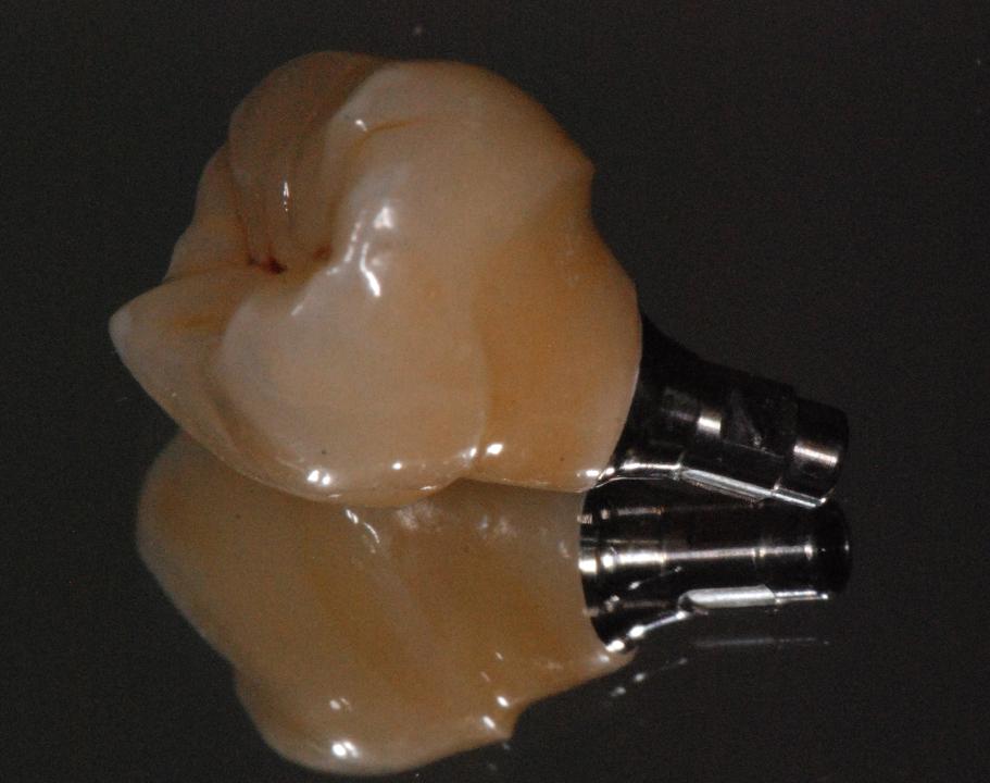 Fig. 13b: All-ceramic screw-retained implant crown on zirconia abutment with metal base (case Fig. 13a)