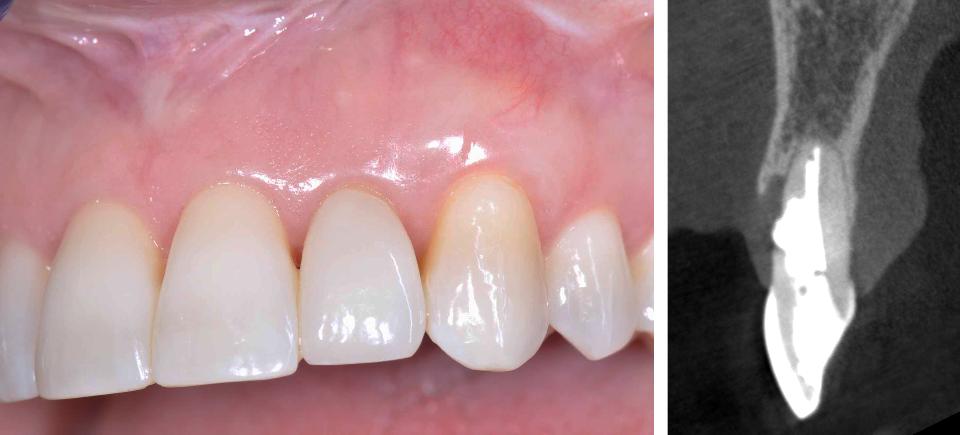Fig. 2c: A deficient facial bone wall and a very thin palatal bone wall