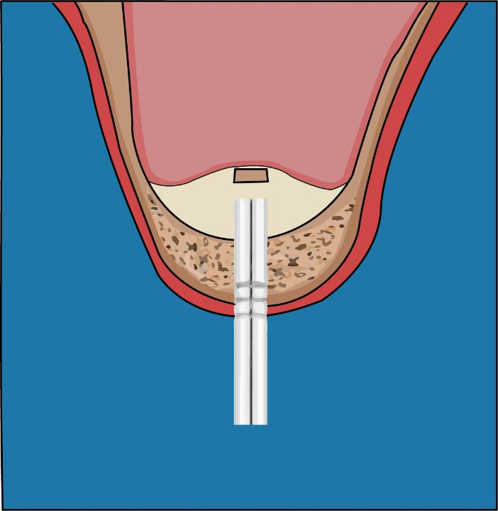 Fig. 5a: Penetrating the sinus floor with concave osteotome