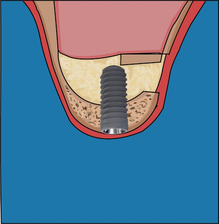 Fig. 4b: Bone graft material filling the space created beneath the sinus membrane and implant placed simultaneously