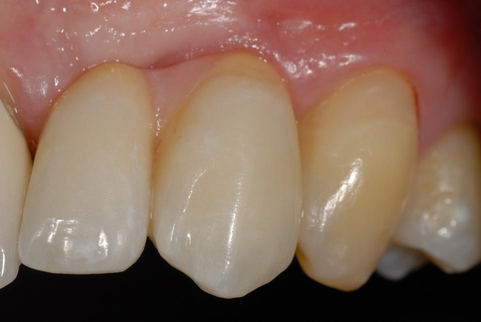 Fig. 4d: The final clinical view shows the screw-retained, 2-unit implant FDP, featuring a mesial cantilever extension. The determining factors for an optimal esthetic integration consisted of the addition of a minimal amount of pink porcelain, the discreet imitation of a root-like cervical portion at elements 22 and 23 as well as the long interdental contact zone between tooth 21 and the mesial aspect of the cantilever unit.