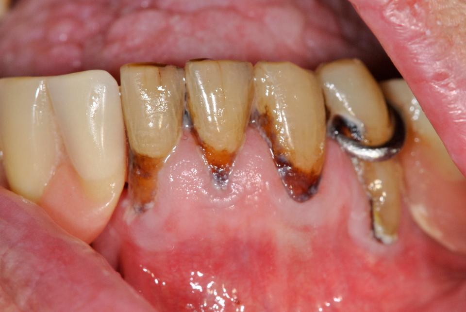 Fig. 8: Dientes pilares de prótesis dental removible (RPD) con lesiones cariosas