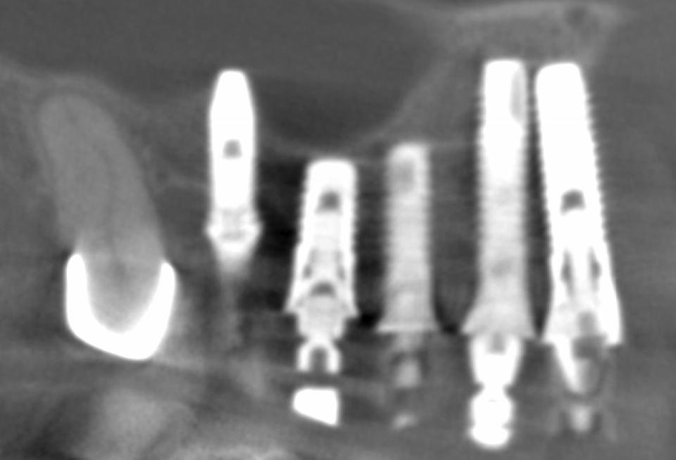 Fig. 11d: The 2D x-ray view of the right maxilla underlines various types of implant malpositions in regard to inter-implant distance, implant depth as well as implant axis