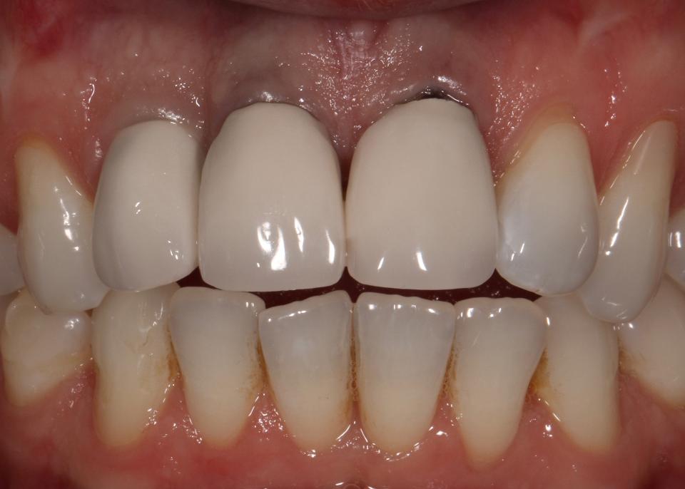 Fig. 16: A thin soft tissue phenotype and inadequate buccal bone thickness have resulted in discoloration of the overlying mucosa when covering three dental implants. However, the peri-implant mucosa was entirely healthy, with no increased PPD or BOP