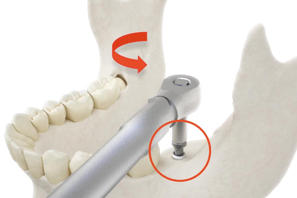 Fig. 10c: The BTI® implant removal kit includes a ratchet to apply a counter-clockwise torque to the implant via the previously described conical screw device