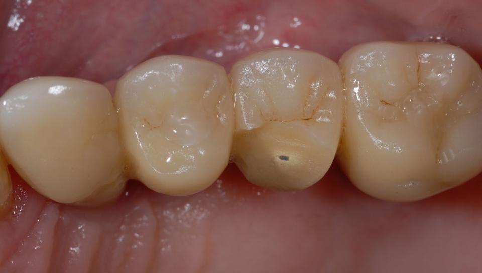 图2: 磨牙症导致23-25种植金属烤瓷固定桥在4年后发生崩瓷(73岁女性，下颌是种植固定修复)[来源:N. U. Zitzmann]